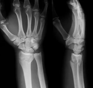 Hands & Wrist Growth - Curio